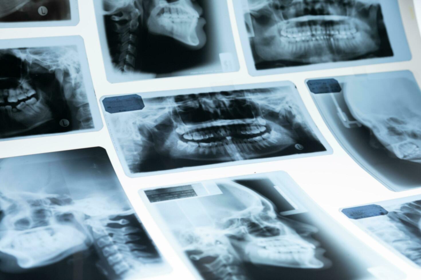 X-Ray scan of human teeth for analyzing and treating. Panoramic dental X-Ray for dentist on white background. photo