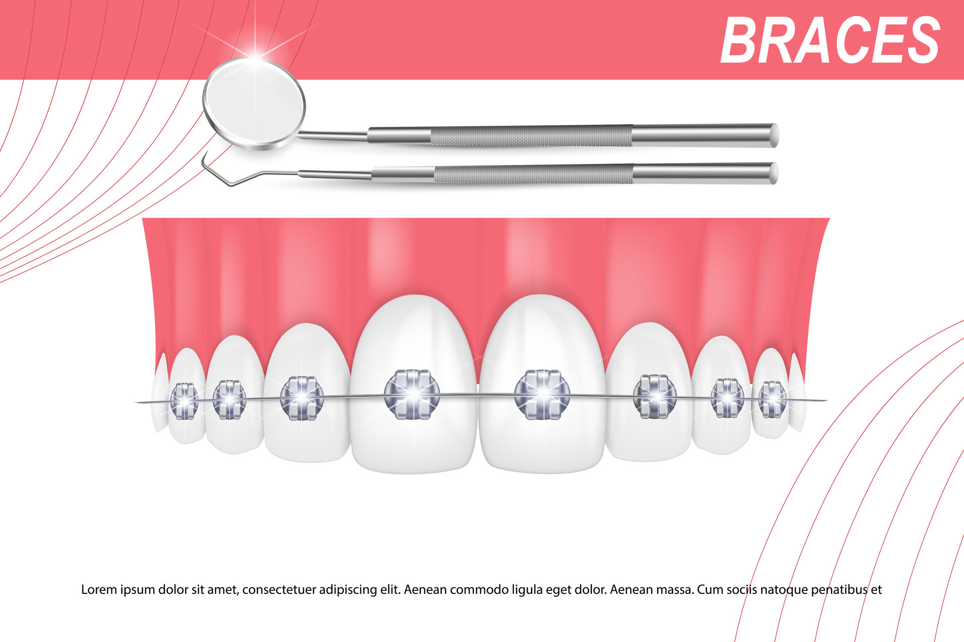 3d vector illustration, realistic teeth with braces upper and lower jaw