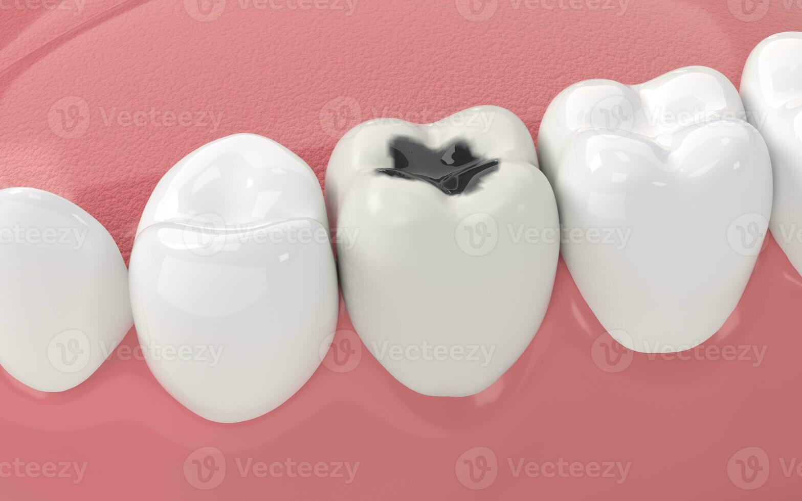 Tooth decay, unhealthy teeth, 3d rendering. photo