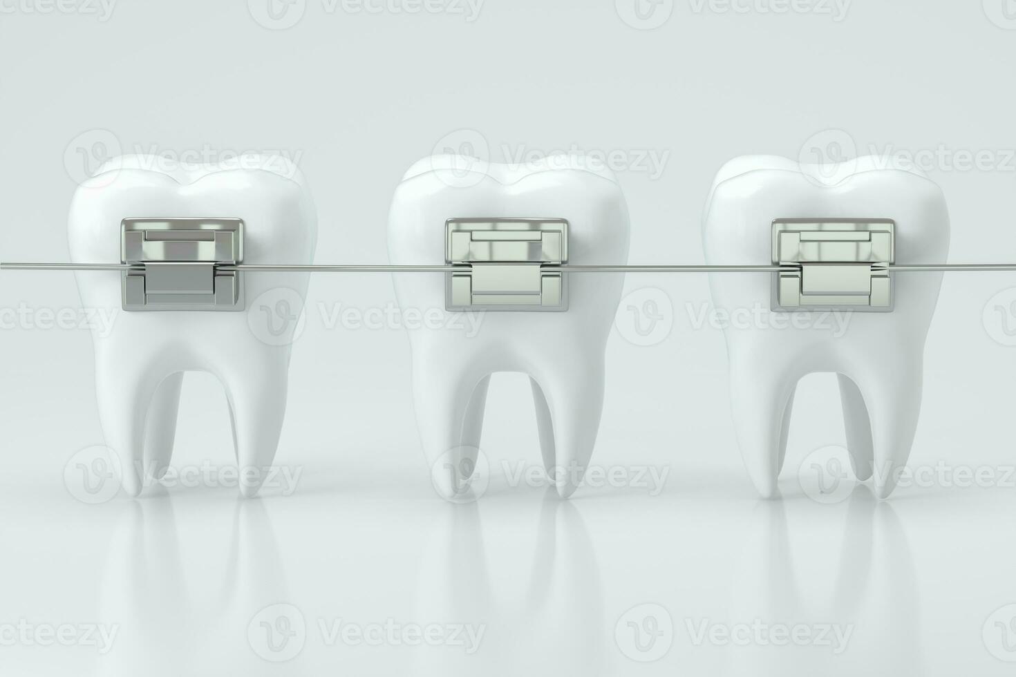 dental tirantes y el dientes, 3d representación. foto