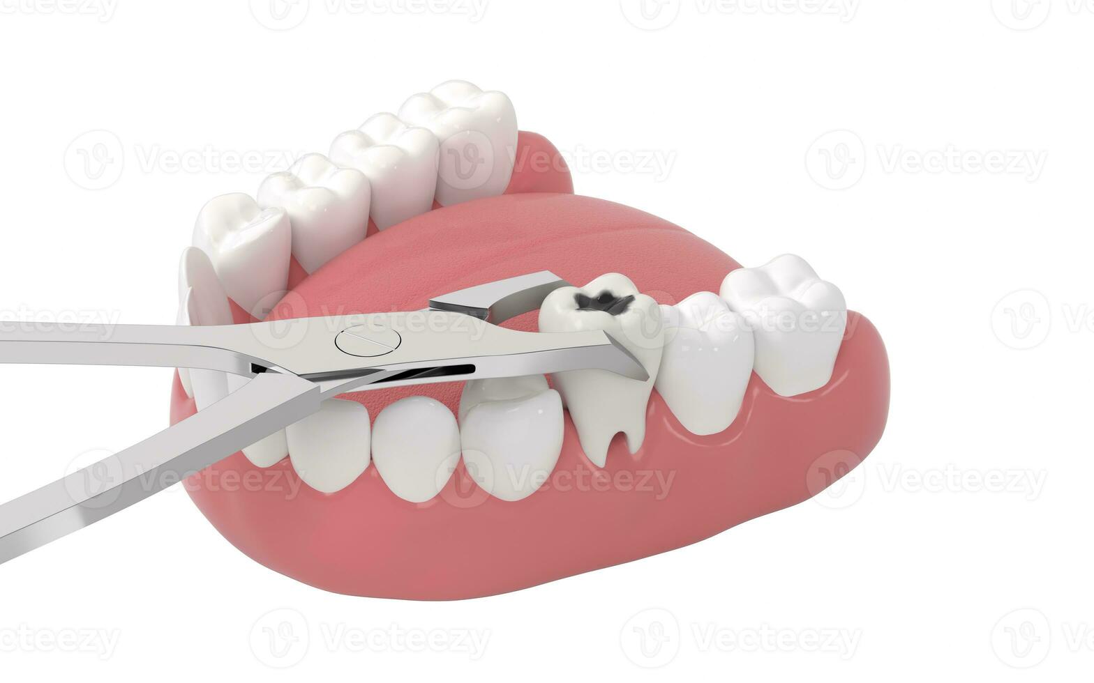 Tooth decay, unhealthy teeth, 3d rendering. photo