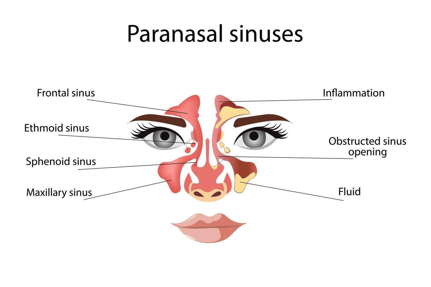 Sinusitis,  Female face with inflammation of the mucous membrane of the paranasal and frontal sinuses. Vector illustration for medical posters and educational materials