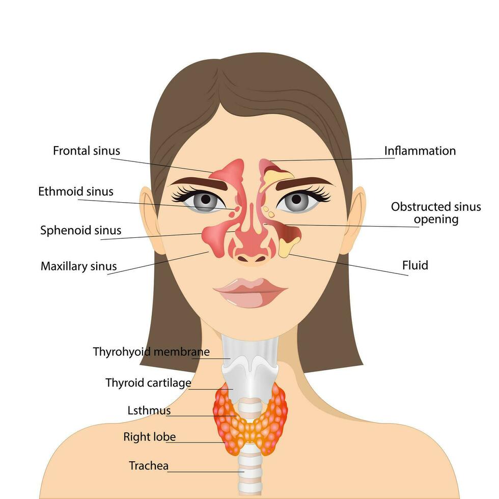 sinusitis, mujer cara con inflamación de el mucoso membrana de el paranasal y frontal senos paranasales. frente ver de el tiroides glándula y tráquea en un blanco antecedentes. humano cuerpo órganos anatomía vector