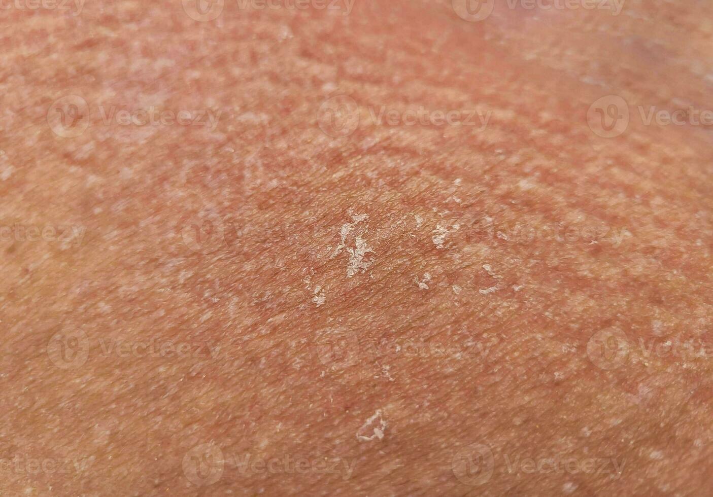 textura de el insalubre humano piel epidermis con escamoso y agrietado partículas cerca arriba. foto