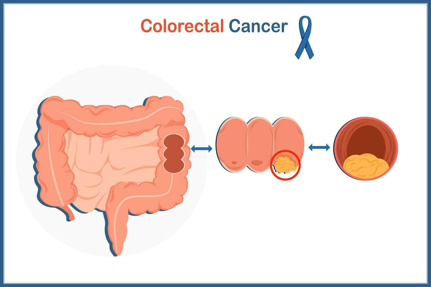 Medical illustration vector concept, digestive system of human colon and colon cancer illustration.isolated on white background,flat style.