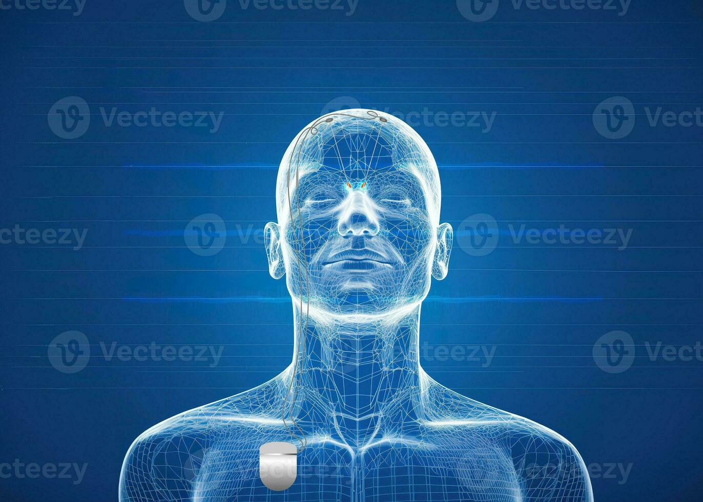 DBS for treatment of Parkinson's disease. Generative Ai photo