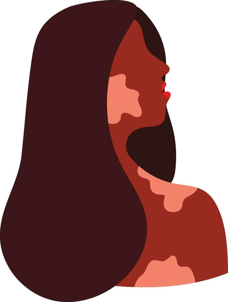 Beautiful Woman with Vitiligo Illustration vector