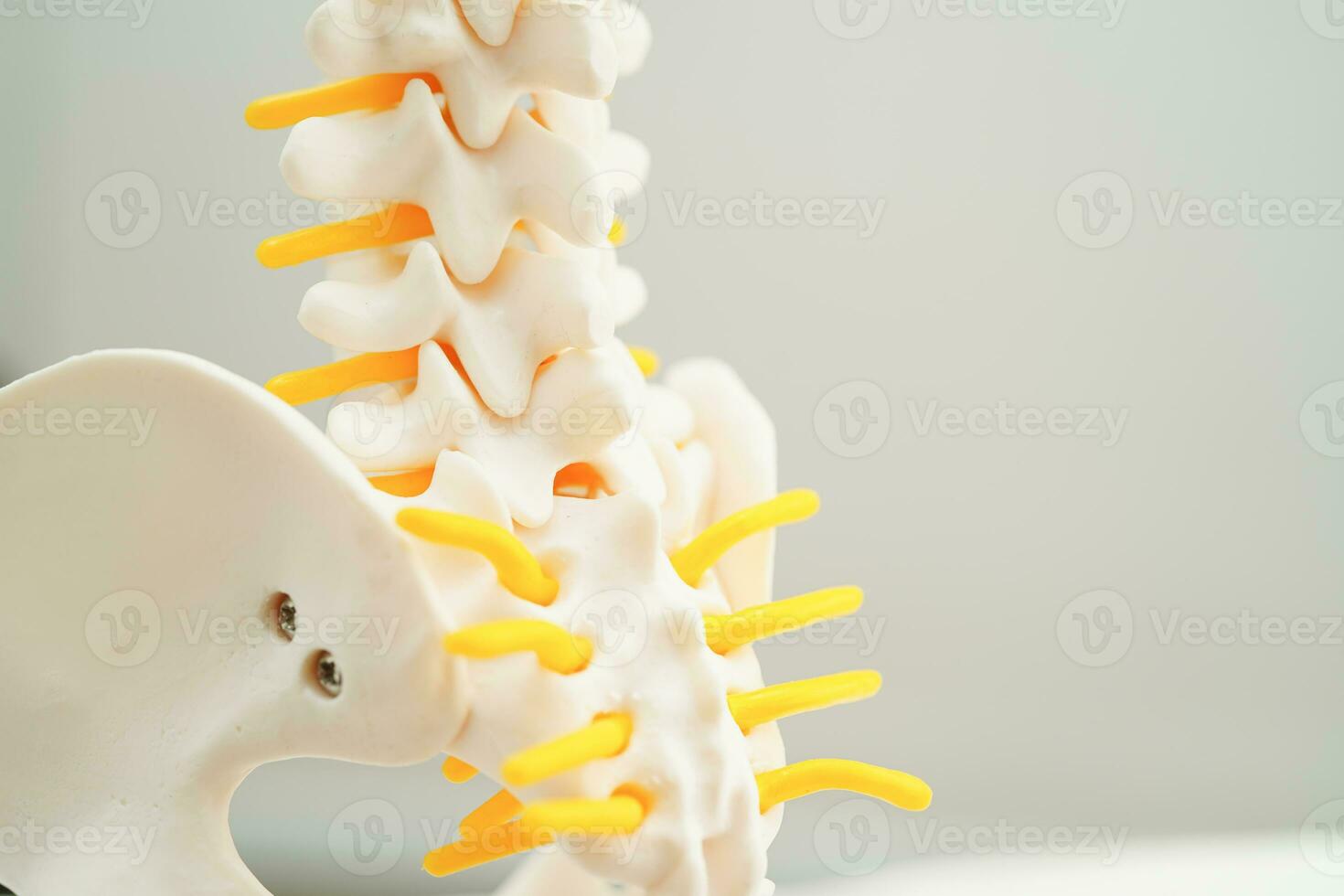 Spinal nerve and bone, Lumbar spine displaced herniated disc fragment, Model for treatment medical in the orthopedic department. photo