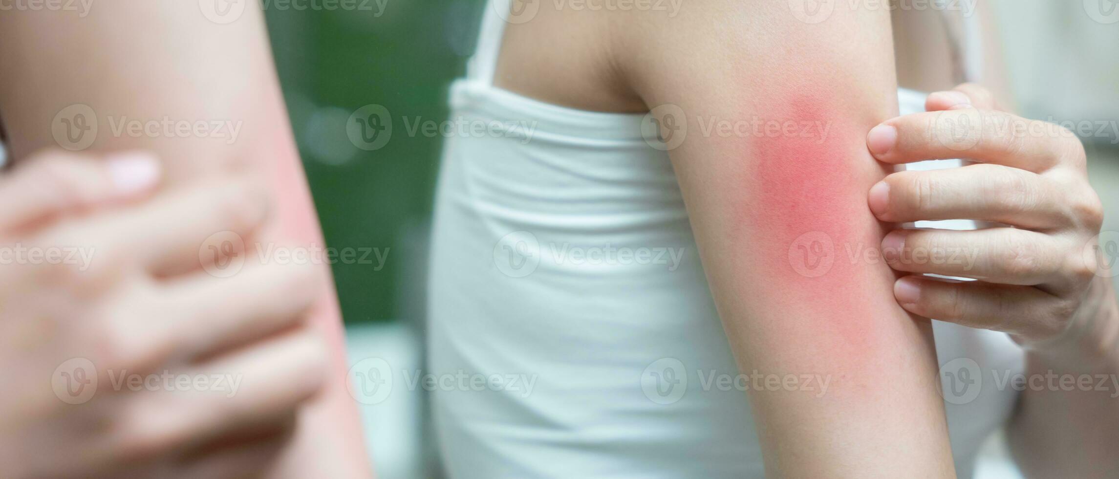 skin problem and beauty. Young woman scratch body has itchy skin from skin allergic, steroid allergy, sensitive skin, red from sunburn, chemical allergy, rash, insect bites, Seborrheic Dermatitis. photo