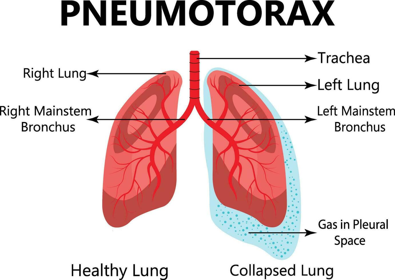 Pneumonia. The anatomical structure of the human lung. Vector illustration on isolated background