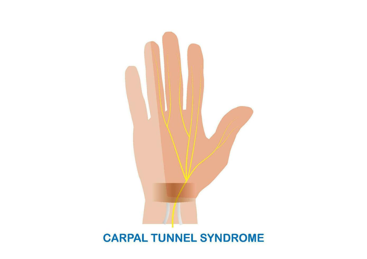 vector ilustración de de mano túnel síndrome