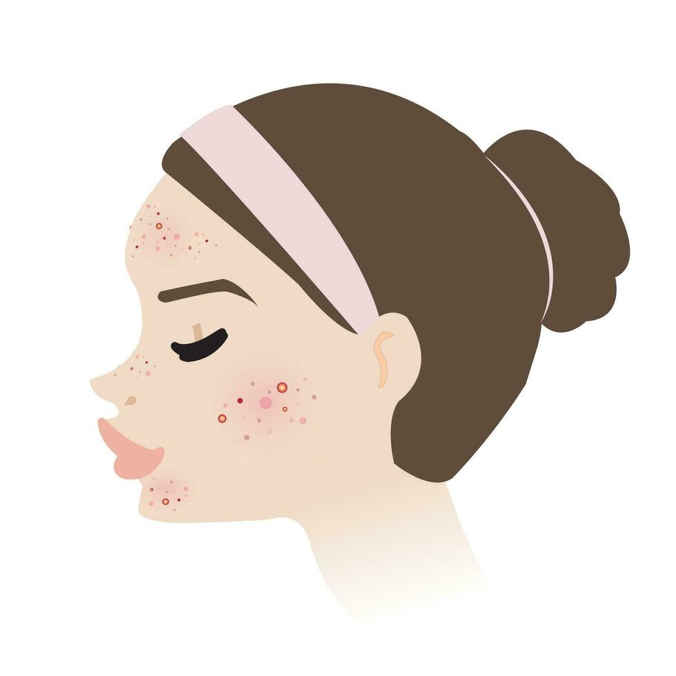 Woman face with acne skin side view vector isolated on white background. Acne, pimples and pustule on face. Non inflammation and inflammation acne. Skin face problem concept illustration.