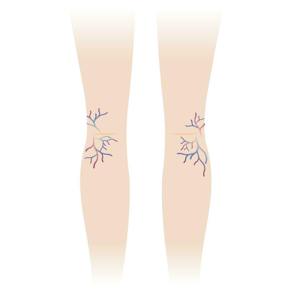 Varicose veins and spider veins on the woman legs vector illustration isolated on white background. Varicose and spider veins are swollen, twisted that become larger, making them show under the skin.