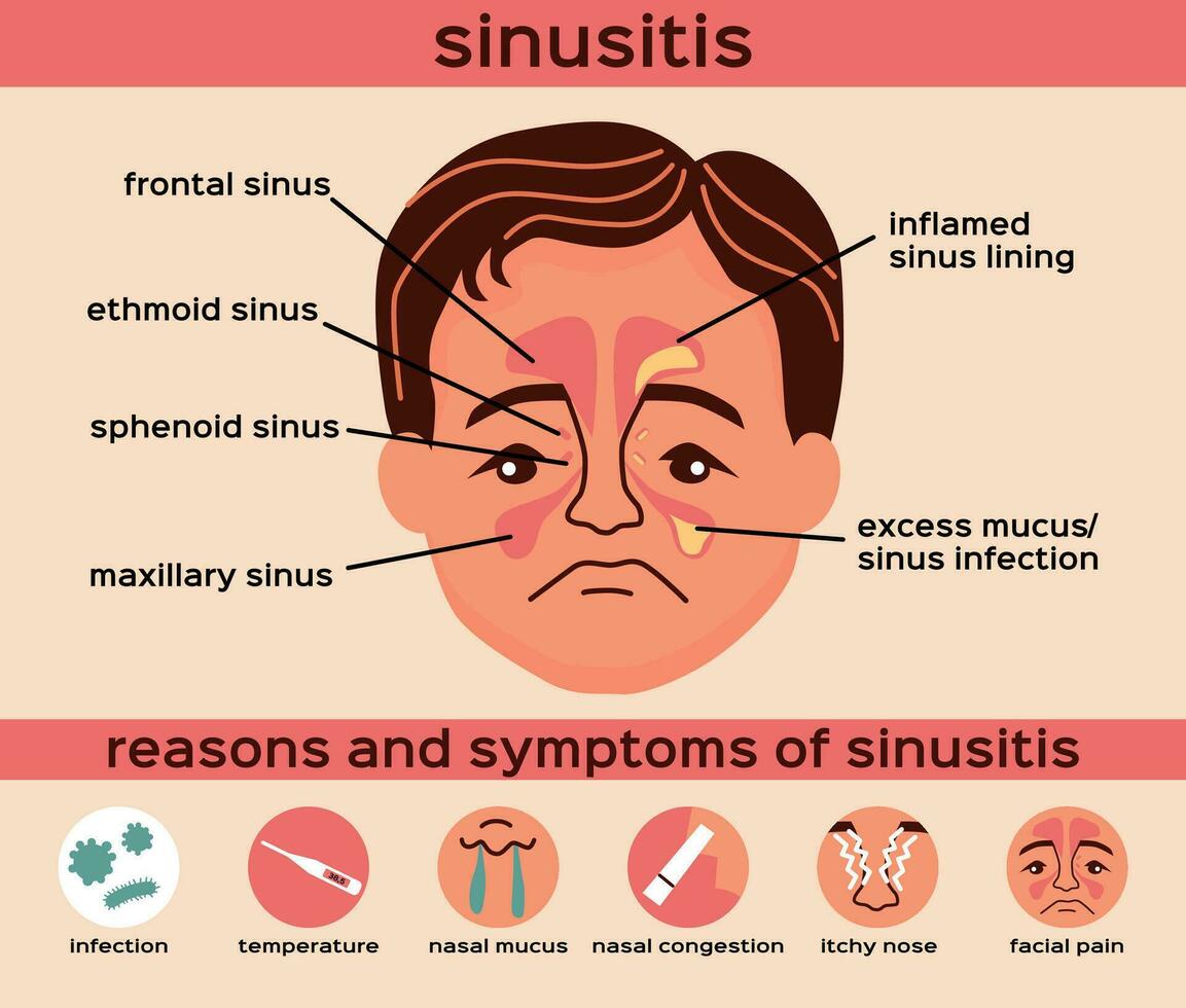 sinusitis plano infografia vector