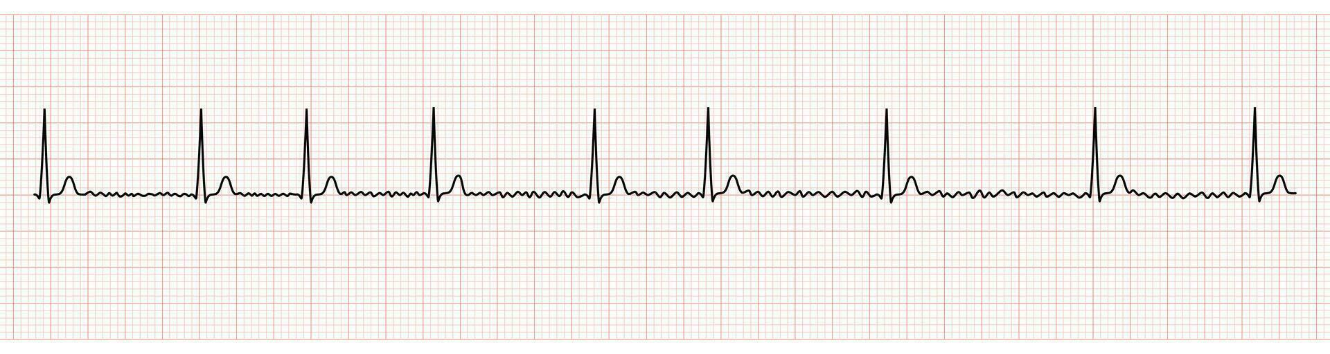 ekg monitor demostración auricular fibrilación con normal ventricular respuesta vector