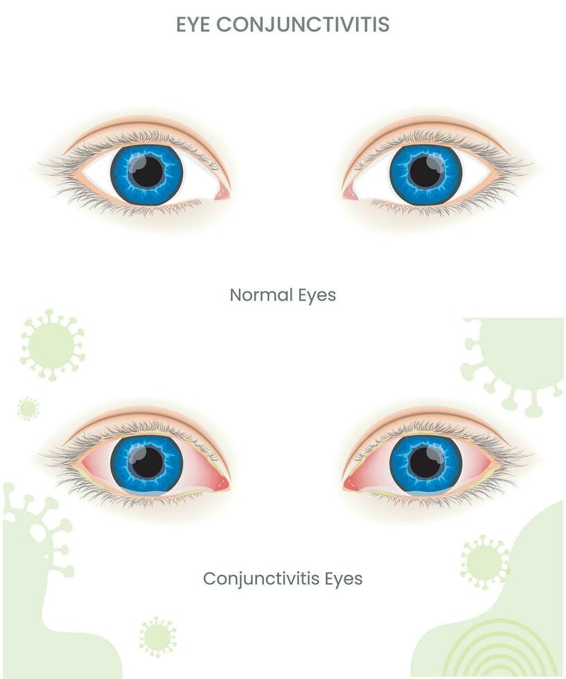 During Pink eye or eye conjunctivitis it shows Eye membrane inflammation, redness, irritation, and discharge vector