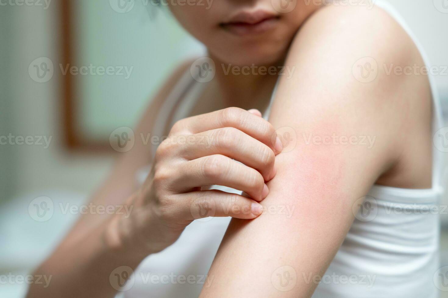 skin problem and beauty. Young woman scratch body has itchy skin from skin allergic, steroid allergy, sensitive skin, red from sunburn, chemical allergy, rash, insect bites, Seborrheic Dermatitis. photo