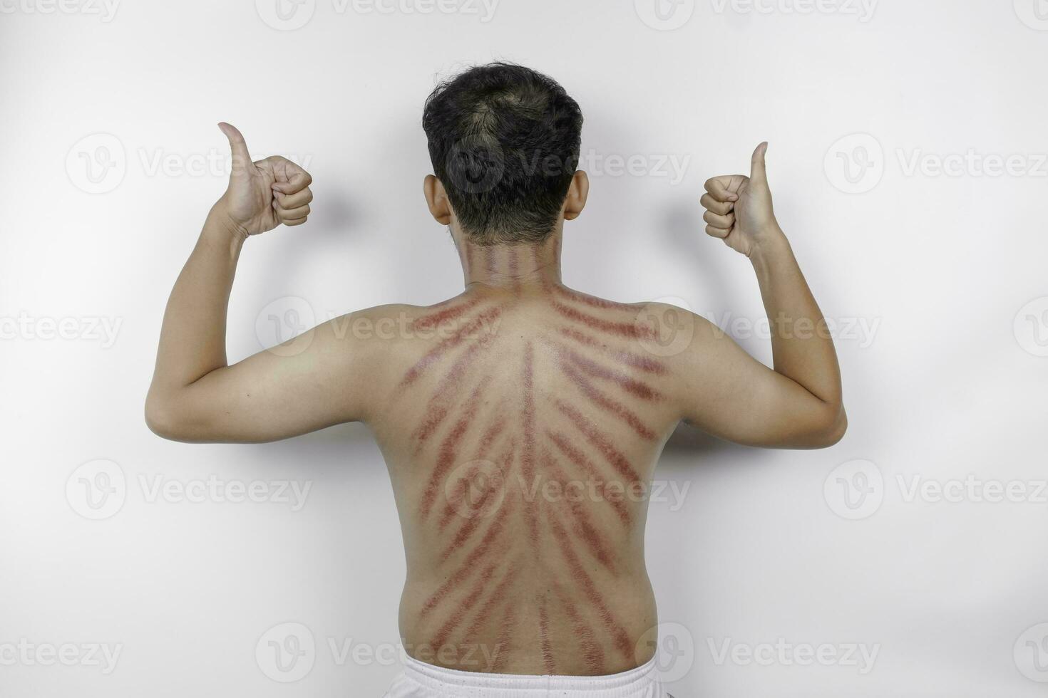 Red marks from scrapes coin on a man's back. Kerokan is a way of traditional Javanese culture medical treatment to treat symptoms of colds in Indonesia photo