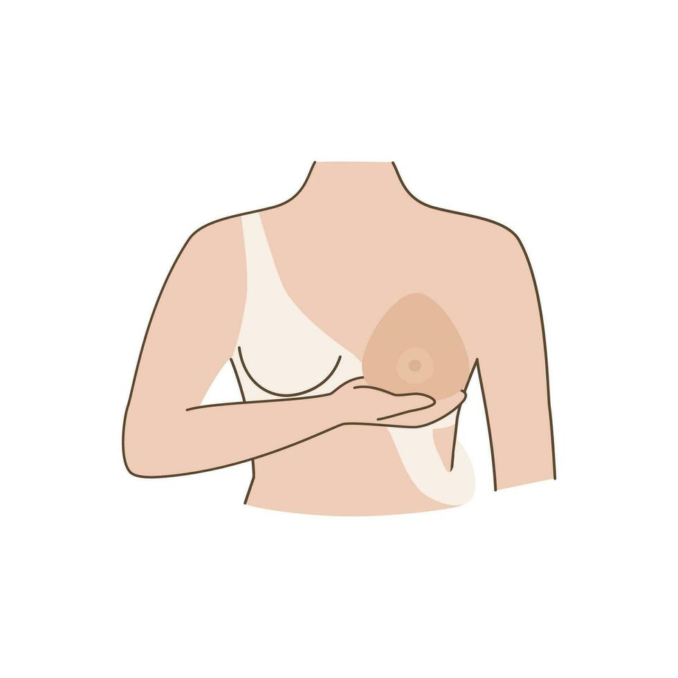 mujer después mastectomía. un niña sin pechos intentos en un pecho prótesis. pecho cáncer. vector ilustración.