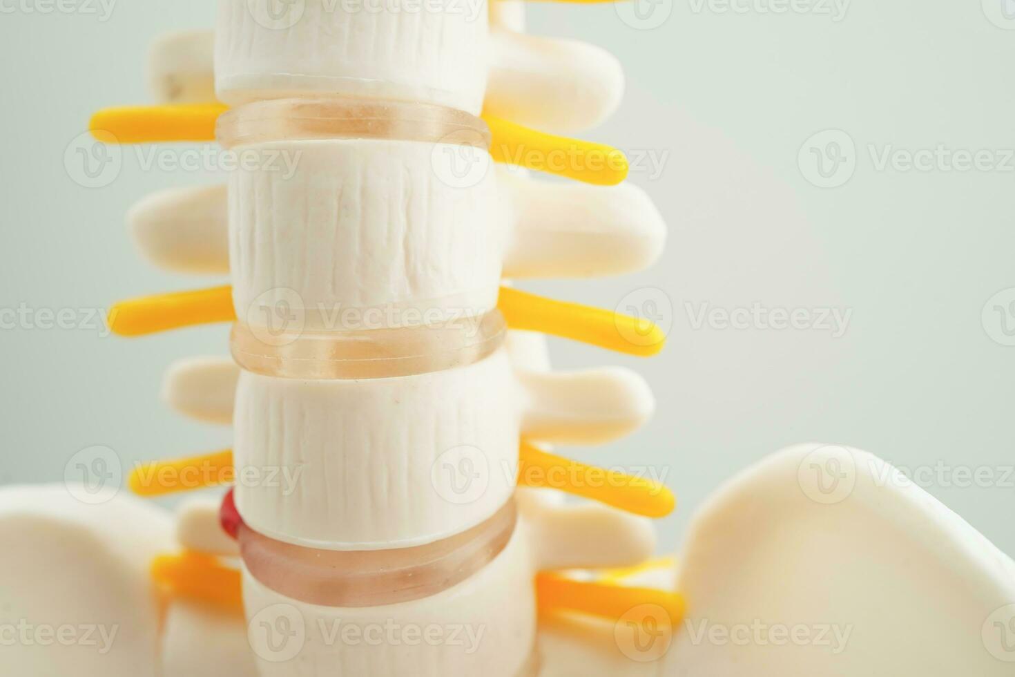 Spinal nerve and bone, Lumbar spine displaced herniated disc fragment, Model for treatment medical in the orthopedic department. photo