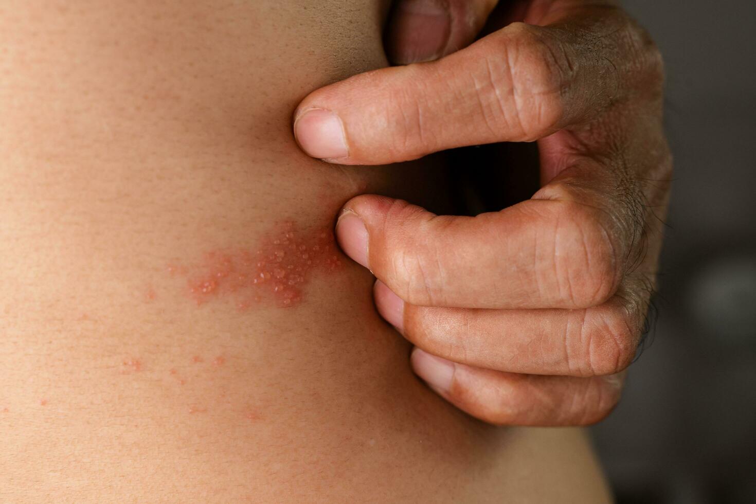 hombre con herpes enfermedad, piel infectado con herpes zóster, virus, cuidado de la salud y médico. foto