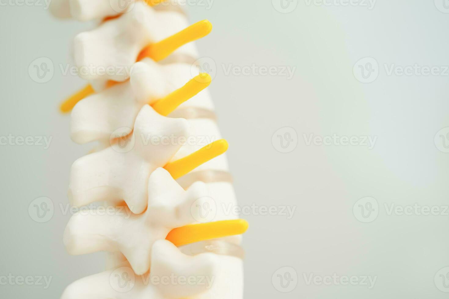 Spinal nerve and bone, Lumbar spine displaced herniated disc fragment, Model for treatment medical in the orthopedic department. photo
