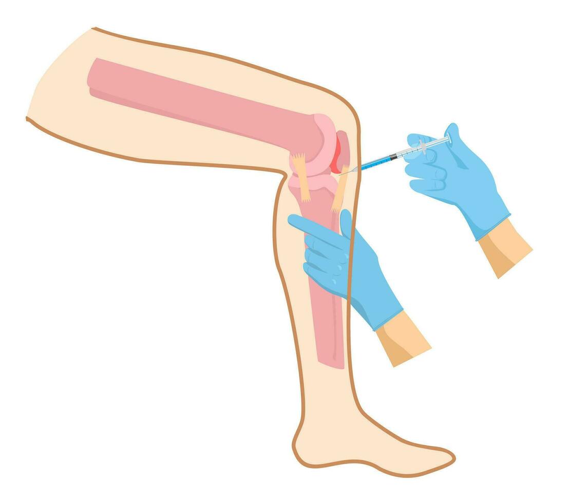 rodilla inyección inflamación enrojecimiento. rodilla inyección concepto. enfermedad de osteoporosis artritis, dolor inflamación, articulación problemas en el piernas vector