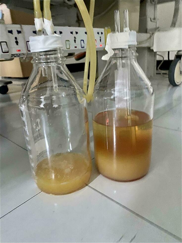 blanco contenido en el botella desde mediastro y peri desagüe son desde quilotórax para médico concepto foto