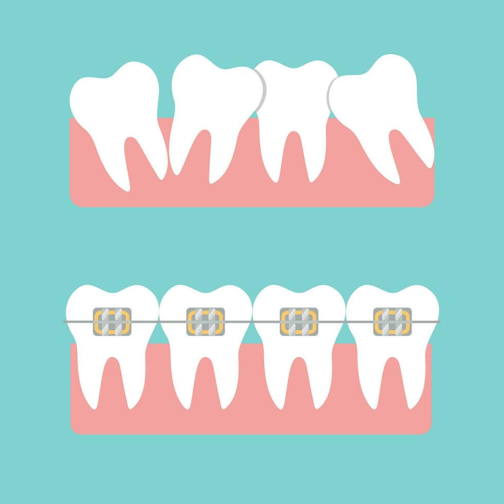 braces crooked teeth, straight teeth with braces vector