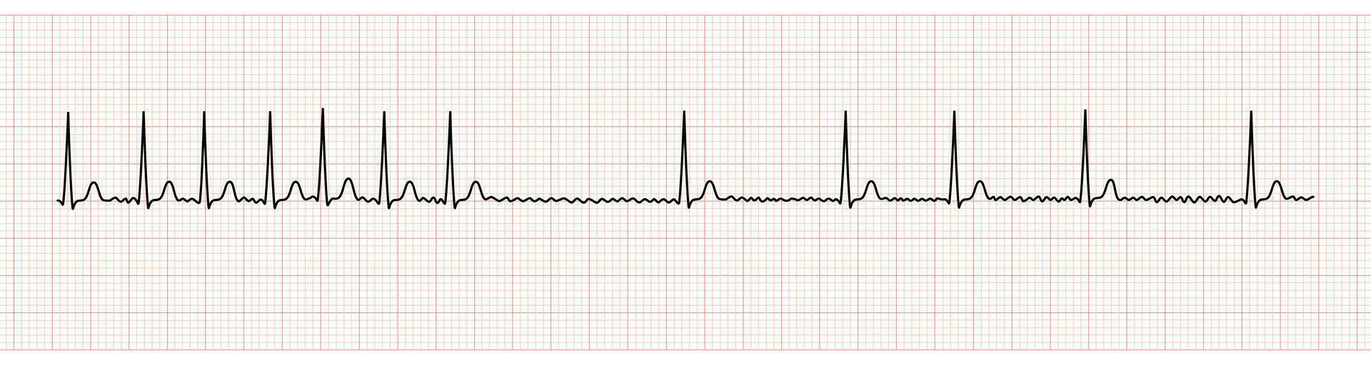 EKG Monitor Showing Atrial Fibrillation With Rapid Ventricular Response and Slower Rate After Adenosine Intravenous vector