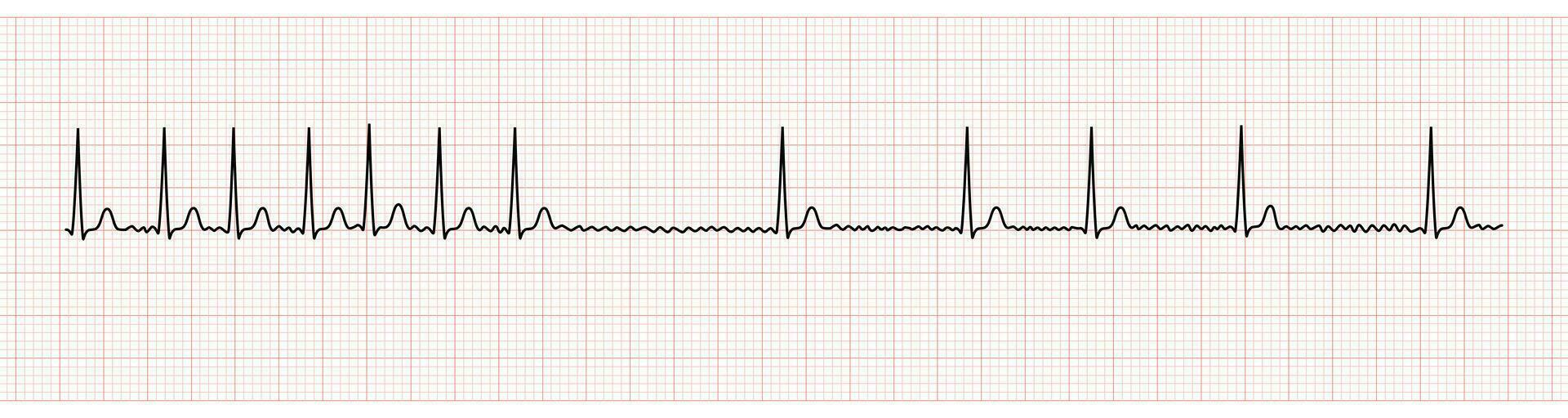 ekg monitor demostración auricular fibrilación con rápido ventricular respuesta y Más lento Velocidad después adenosina intravenoso vector