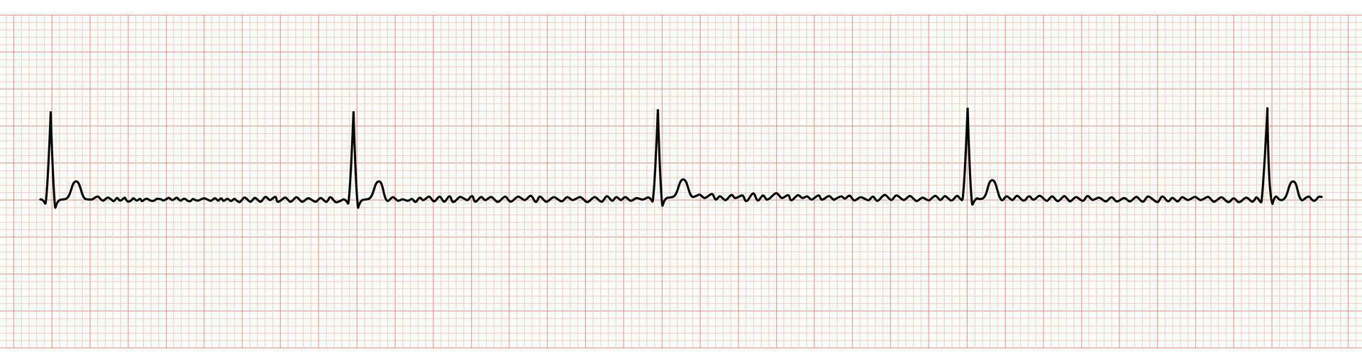 EKG Monitor Showing Regularized Atrial Fibrillation or AF with Block vector