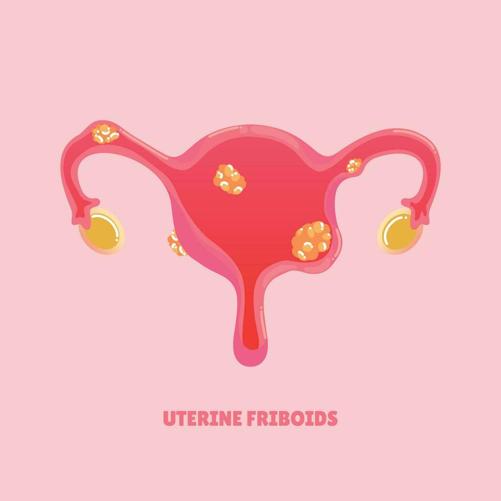 uterine fibroids disease vector illustration