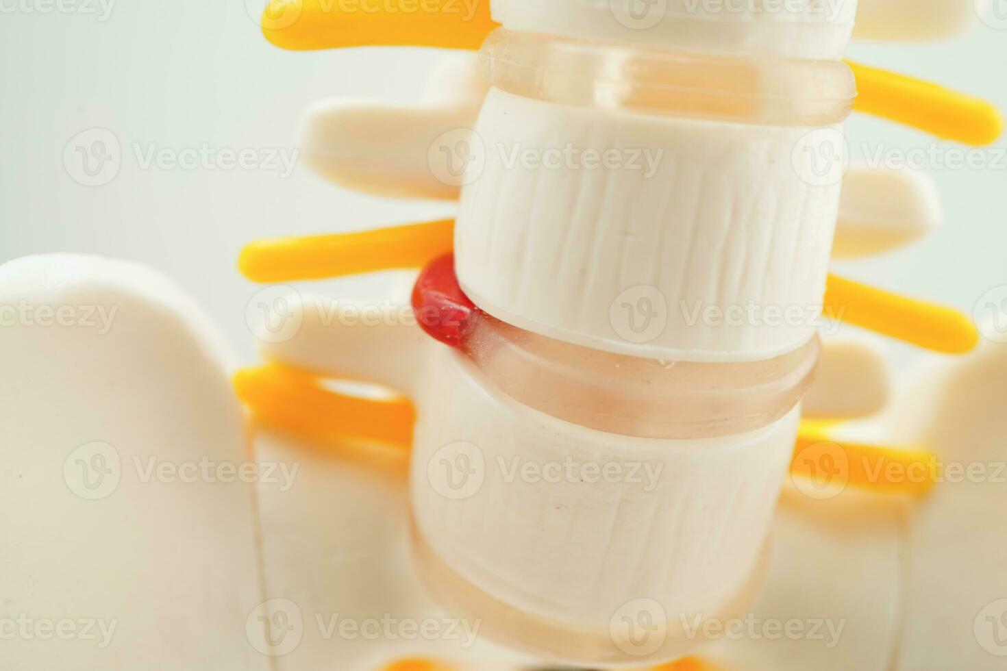Spinal nerve and bone, Lumbar spine displaced herniated disc fragment, Model for treatment medical in the orthopedic department. photo