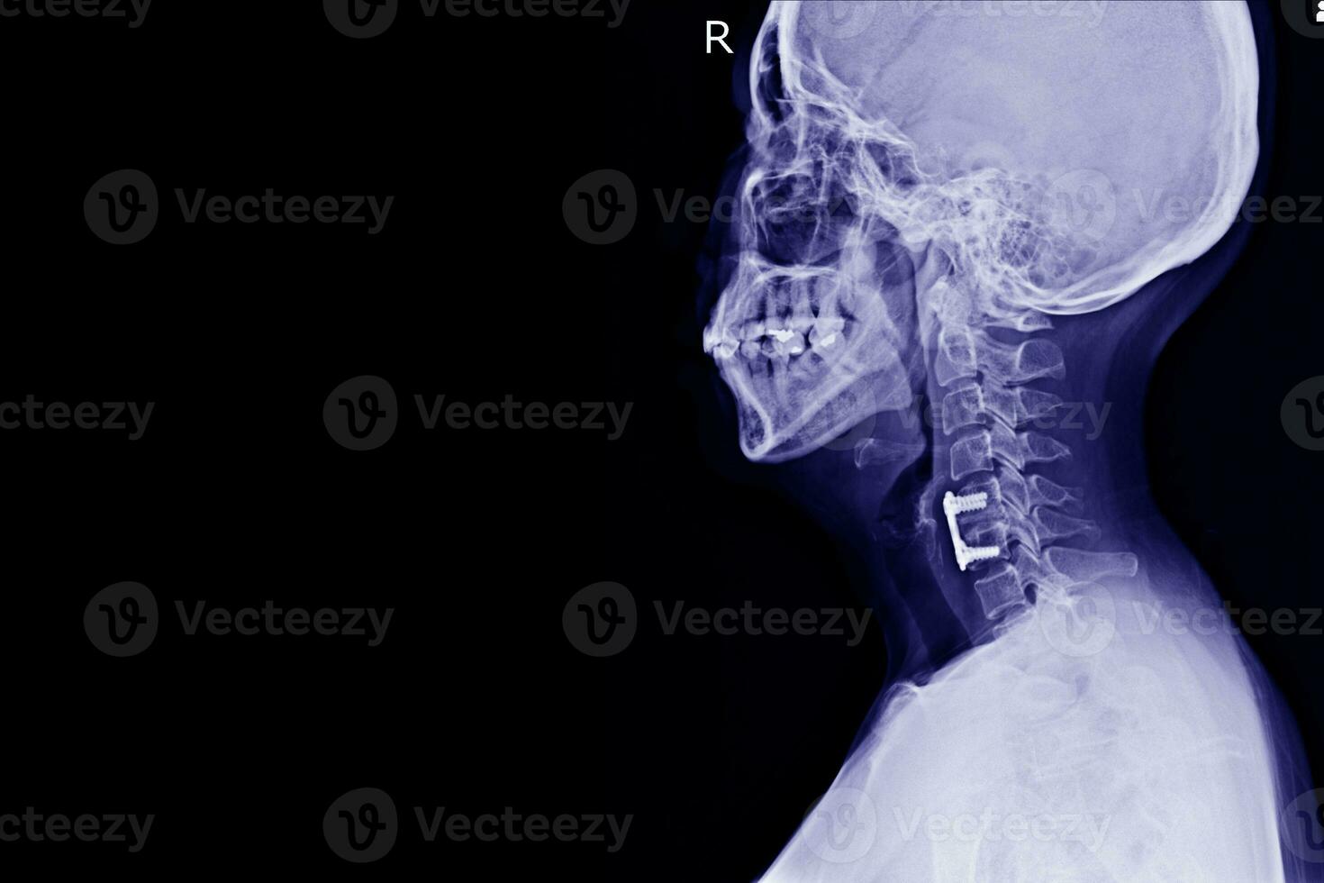 X-ray C-Spine Lateral views Post operation spinal fixcation of C5-6 bodies Showing No spinal dislocation.Medical concept photo