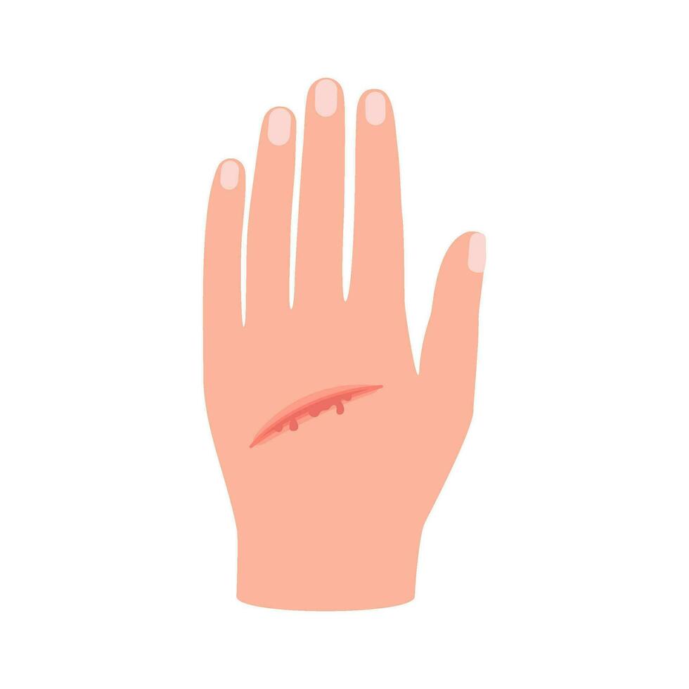 Wound of hand human skin, scratch. Cut injury skin, bleeding cut. Vector illustration