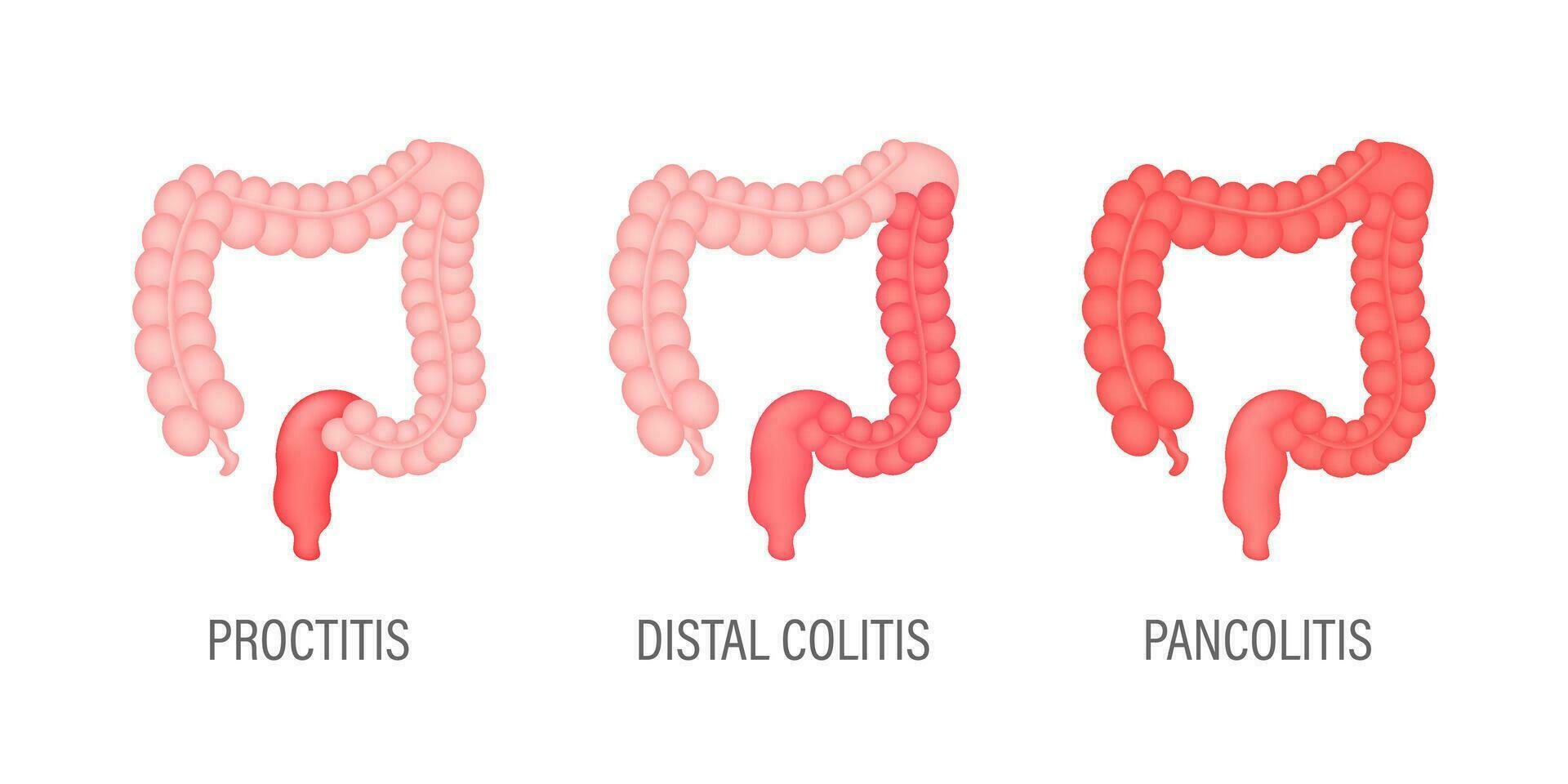 colitis para médico diseño. gastroenterología. intestino estreñimiento icono diseño. salud cuidado. vector valores ilustración