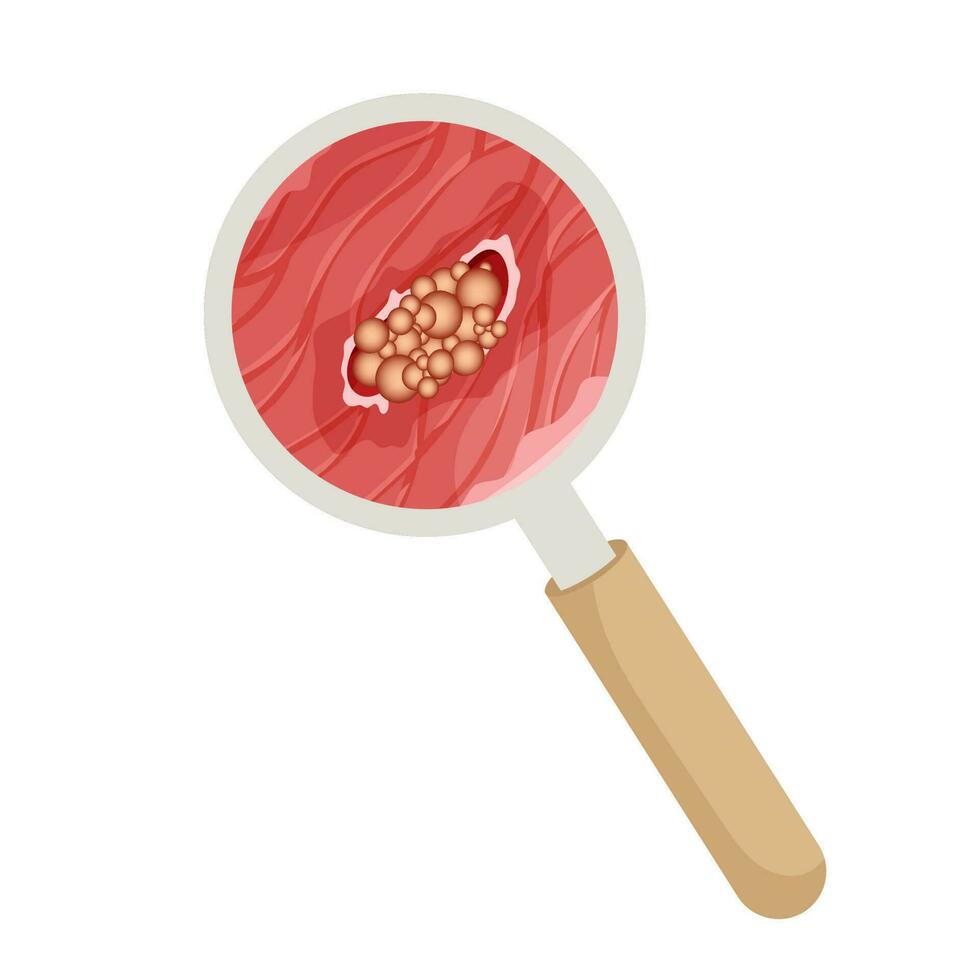 Cancer. Malignant cancerous tumor enlarged under magnifying glass. Anatomical vector illustration isolated white background cartoon style
