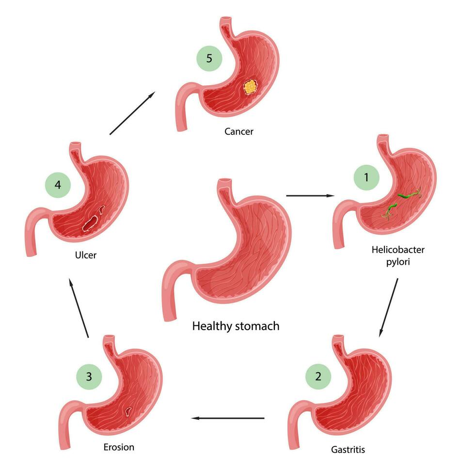 estómago enfermedades. diagrama de enfermedades de helicobacter pylori, gastritis, erosión, úlcera y cáncer. educativo anatómico vector ilustración