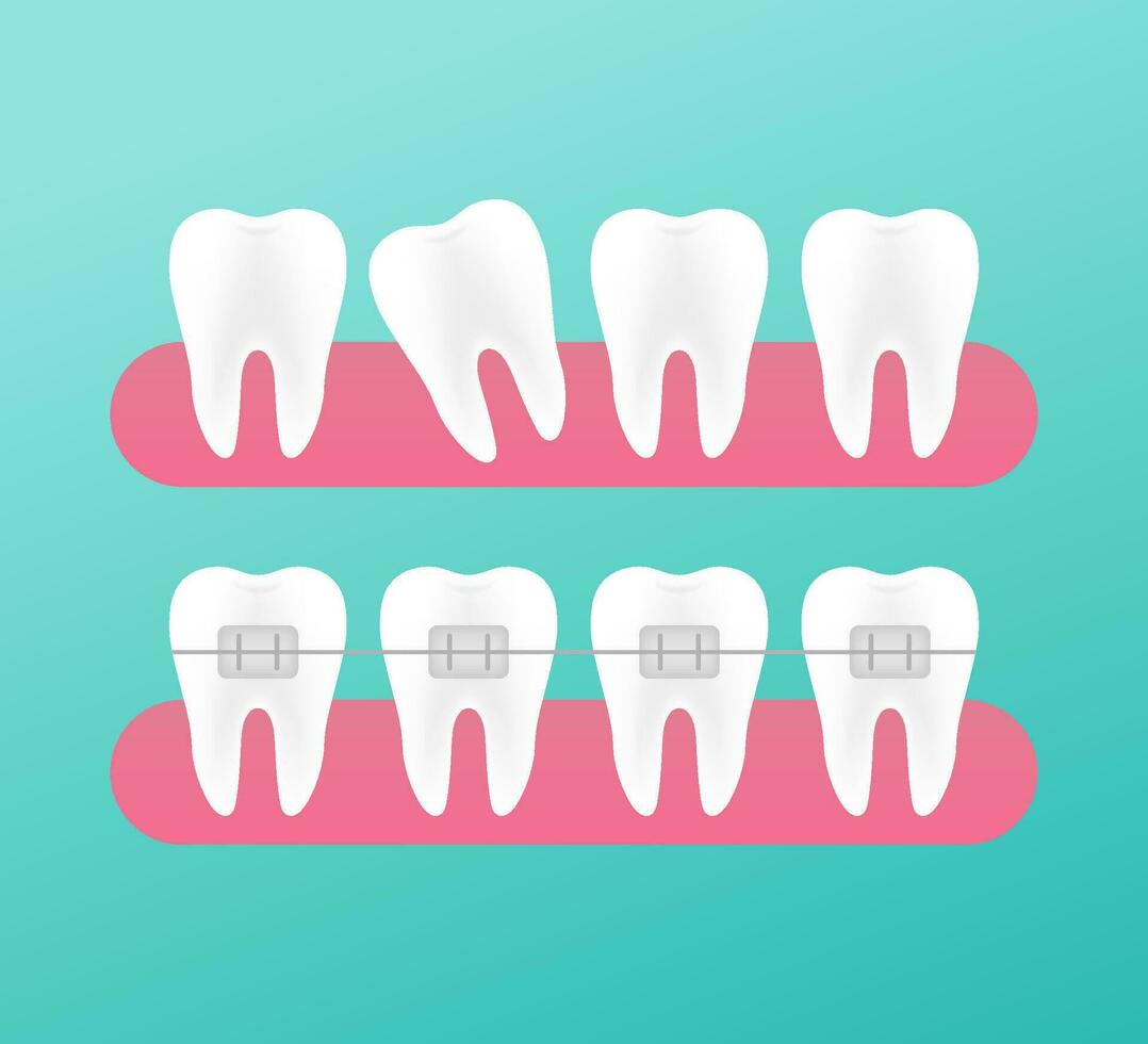 Correction of teeth with orthodontic braces. Stages of teeth alignment. Dental clinic services. Vector illustration