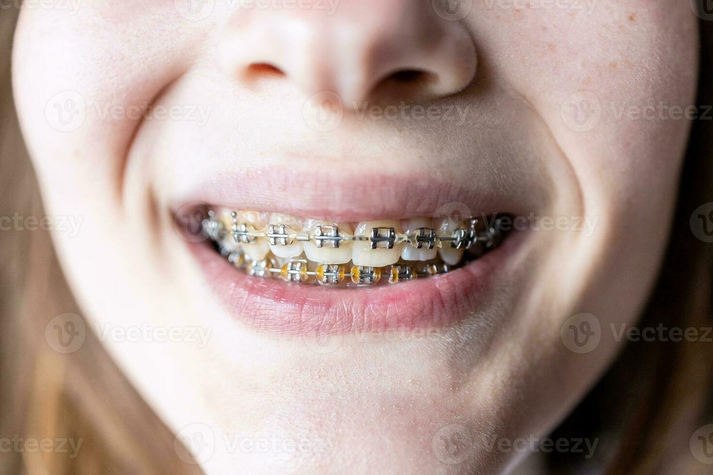 view of dental brackets on teeth of teenager photo