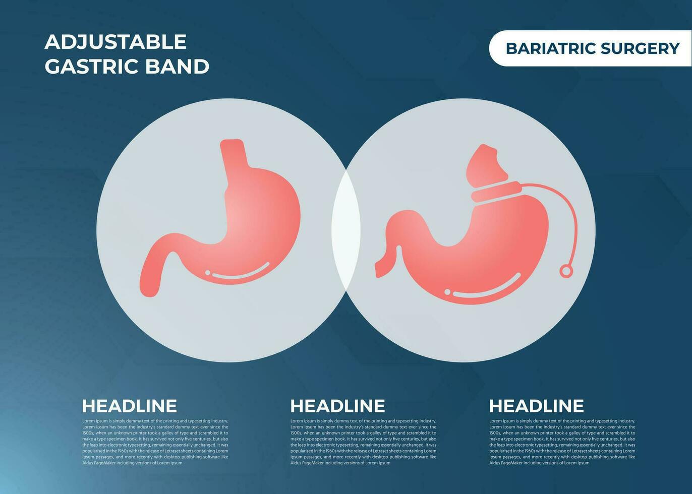 ilustración de banda gástrica ajustable diseñar vector de cirugía de pérdida de peso