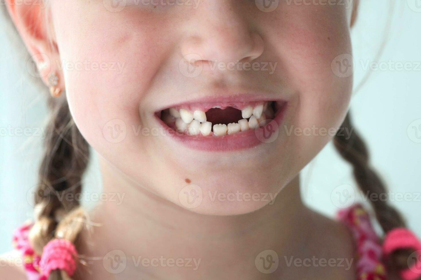 Close-up smile of a girl. A beautiful little girl 6-7 years old has lost milk teeth. Loss of milk teeth, replacement of permanent teeth. photo