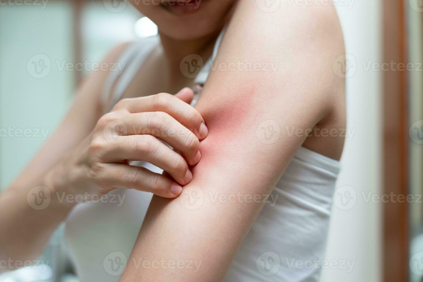skin problem and beauty. Young woman scratch body has itchy skin from skin allergic, steroid allergy, sensitive skin, red from sunburn, chemical allergy, rash, insect bites, Seborrheic Dermatitis. photo