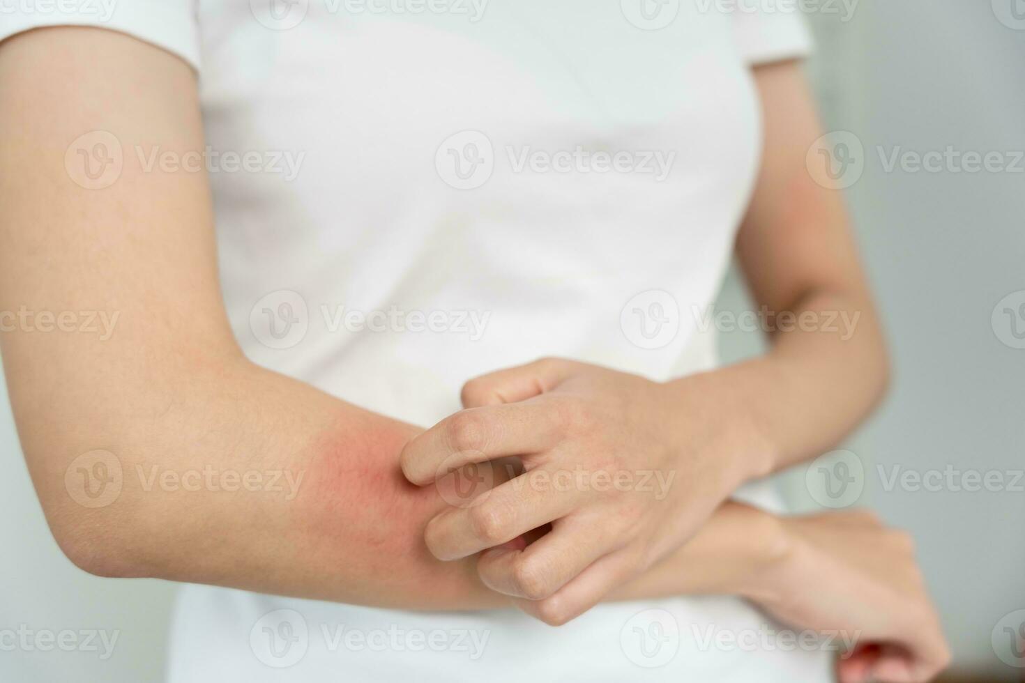 skin problem and beauty. Young woman scratch body has itchy skin from skin allergic, steroid allergy, sensitive skin, red from sunburn, chemical allergy, rash, insect bites, Seborrheic Dermatitis. photo