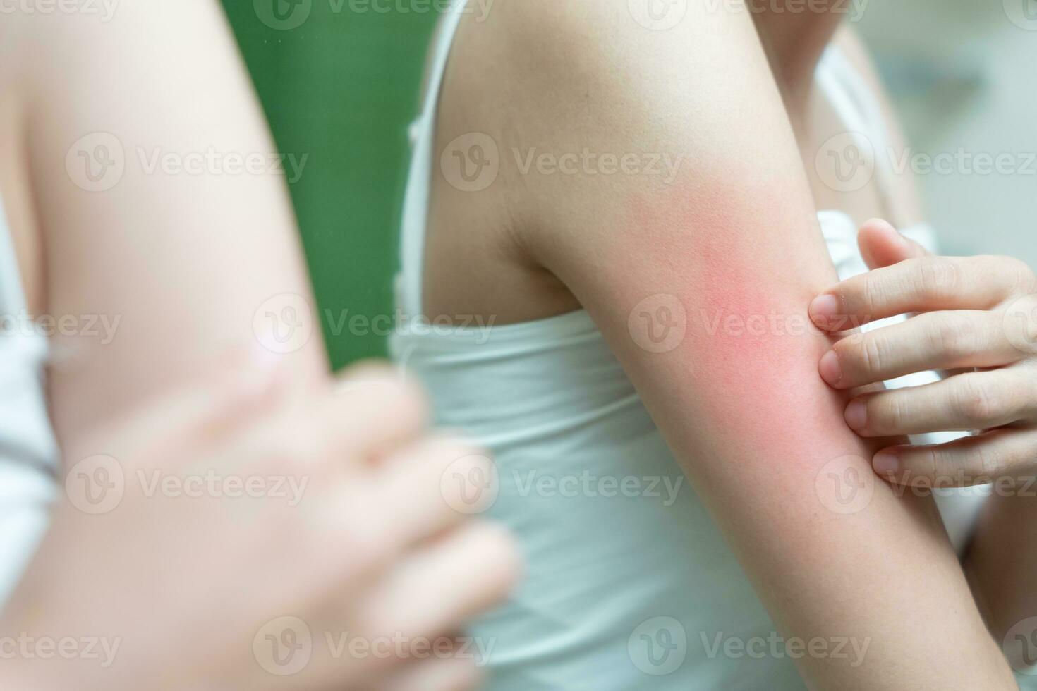 skin problem and beauty. Young woman scratch body has itchy skin from skin allergic, steroid allergy, sensitive skin, red from sunburn, chemical allergy, rash, insect bites, Seborrheic Dermatitis. photo