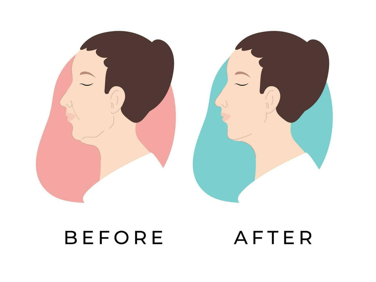 mujer perfil. hembra cara antes de y después recepción hardware cosmetología procedimiento. doble mentón. mujer rostro. vector ilustración