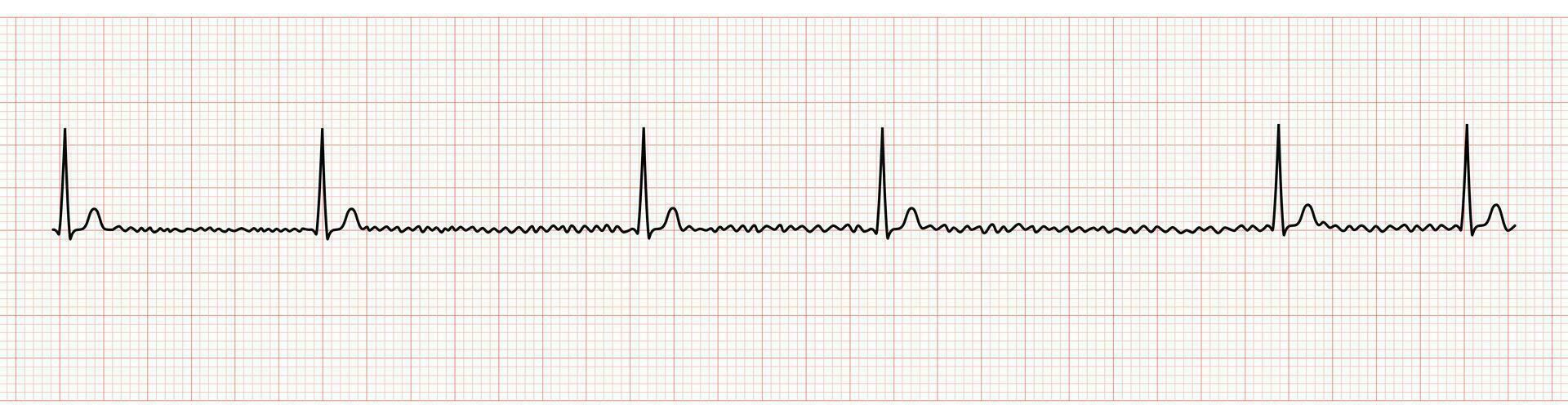 EKG Monitor Showing Atrial Fibrillation With Slow Ventricular Response vector