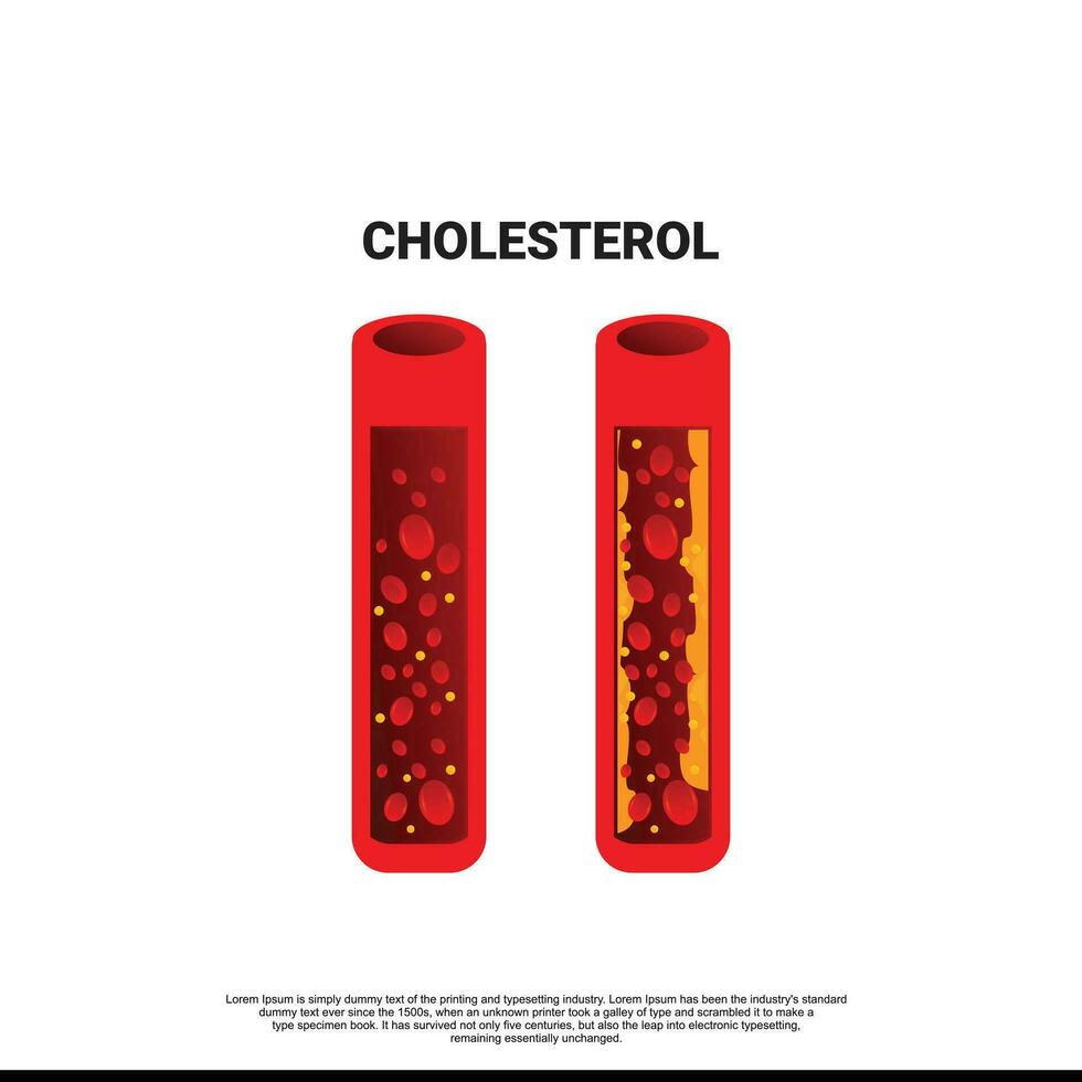 Coronary artery disease is the buildup of plaque in the arteries that supply oxygen-rich blood to your heart. Plaque causes a narrowing or blockage that could result in a heart attack vector