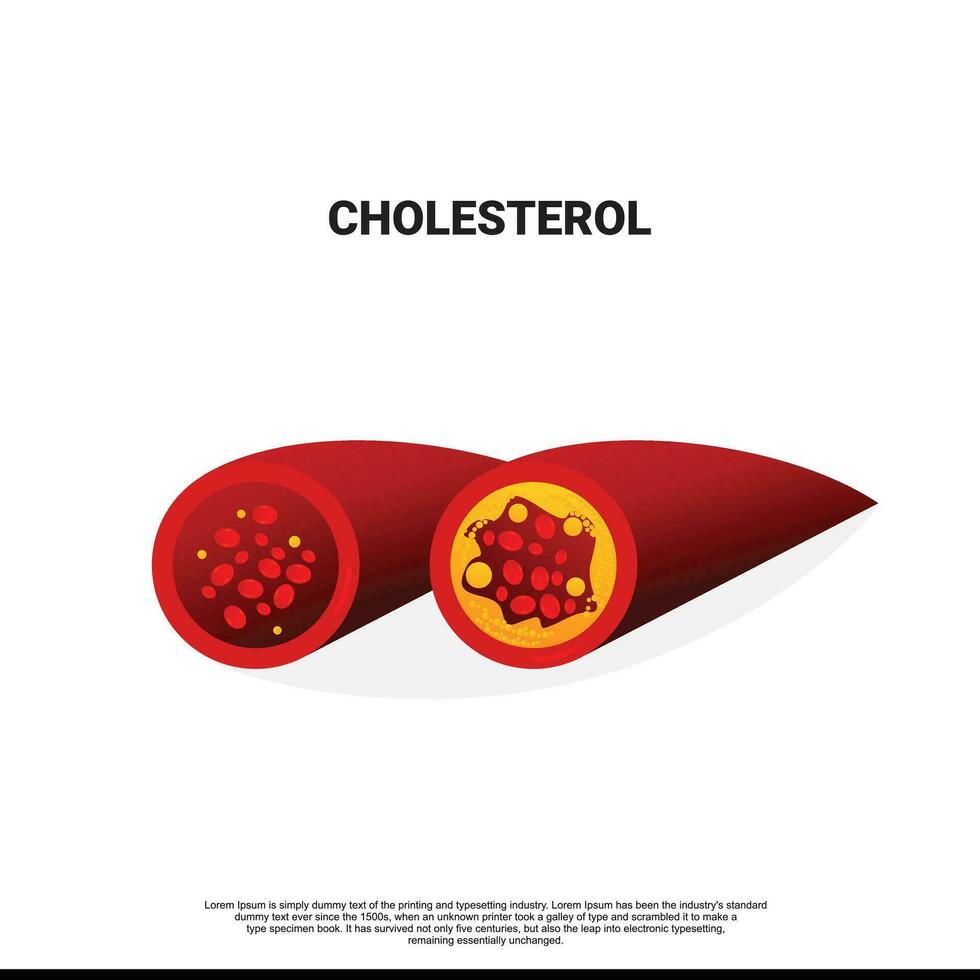 Coronary artery disease is the buildup of plaque in the arteries that supply oxygen-rich blood to your heart. Plaque causes a narrowing or blockage that could result in a heart attack vector